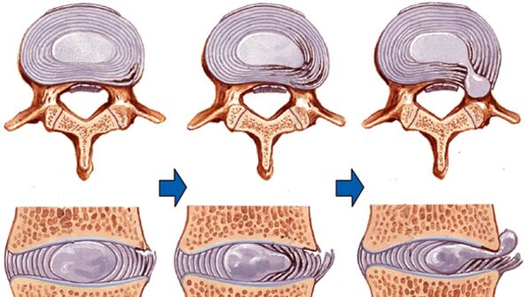 blessure à la colonne vertébrale dans l'ostéochondrose