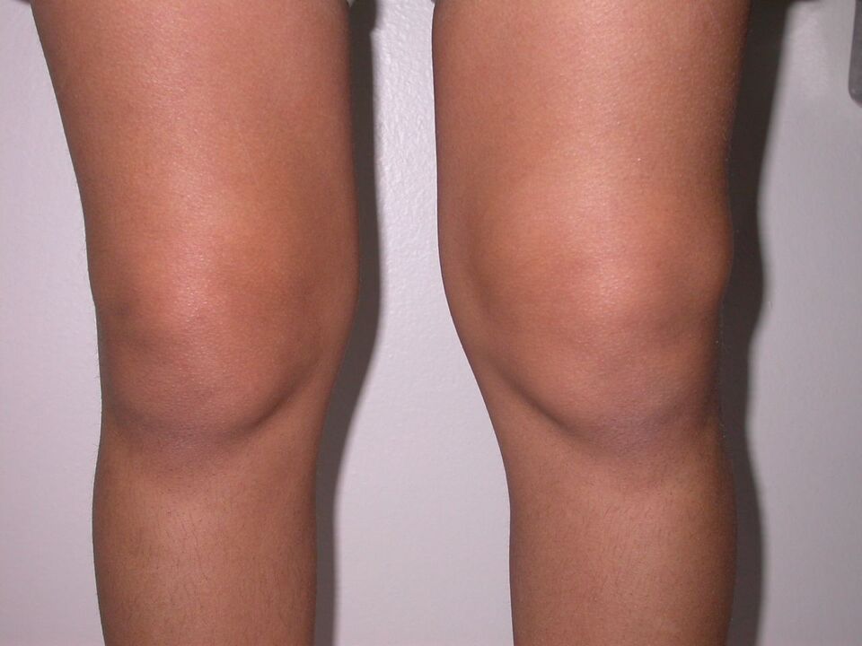 gonflement du genou dû à l'arthrose