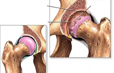 Diagnostic de l'arthrose de la hanche