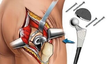 Endoprothétique pour l'arthrose de la hanche