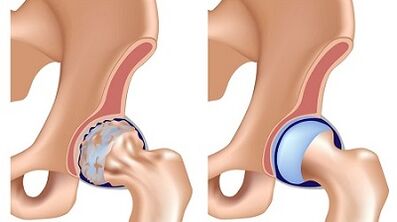 Symptômes d'arthrose de l'articulation de la hanche