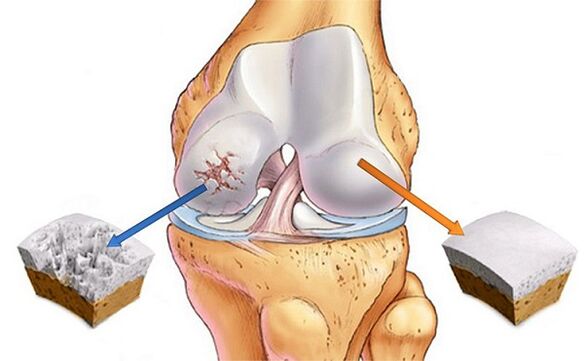 Norme et déviation pour l'arthrose de l'articulation du genou