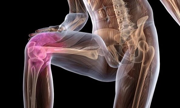 Signes et symptômes d'arthrose de l'articulation du genou