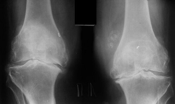 X -RAY comme moyen de diagnostiquer l'arthrose de l'articulation du genou