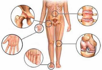 Arthrite et arthrose de diverses articulations