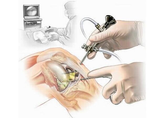 Arthroscopie articulaire du genou