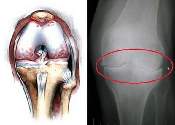 La déformation de l'articulation du genou pour l'arthrose