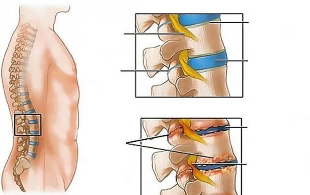 l'ostéochondrose de la colonne lombaire provoque des maux de dos